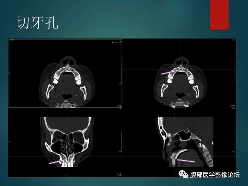 影像PPT - 【PPT】三叉孔道弯弯绕-81 影像PPT - 【PPT】三叉孔道弯弯绕-81
