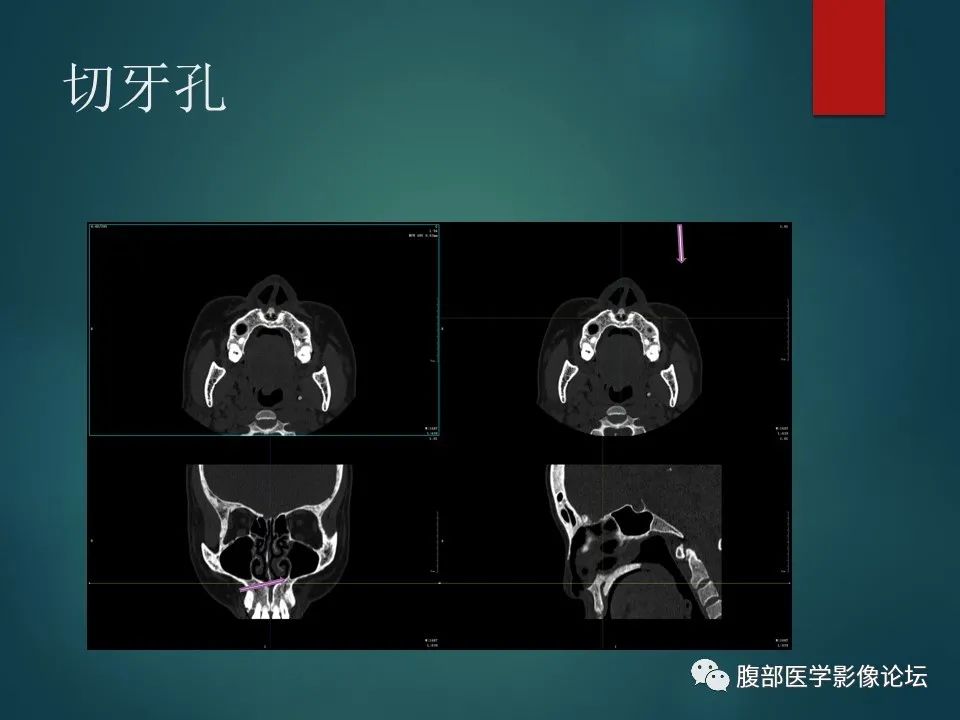 影像PPT - 【PPT】三叉孔道弯弯绕-82 影像PPT - 【PPT】三叉孔道弯弯绕-82