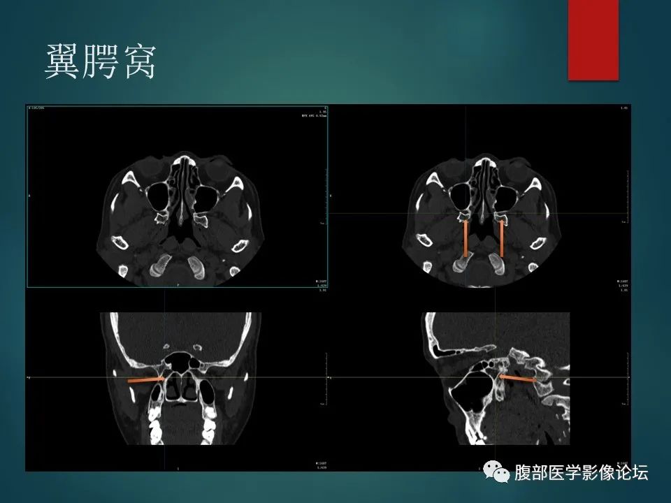 影像PPT - 【PPT】三叉孔道弯弯绕-83 影像PPT - 【PPT】三叉孔道弯弯绕-83