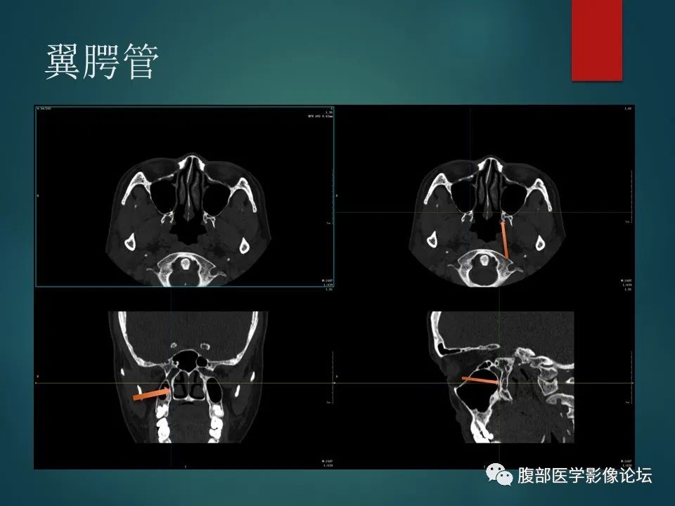 影像PPT - 【PPT】三叉孔道弯弯绕-84 影像PPT - 【PPT】三叉孔道弯弯绕-84