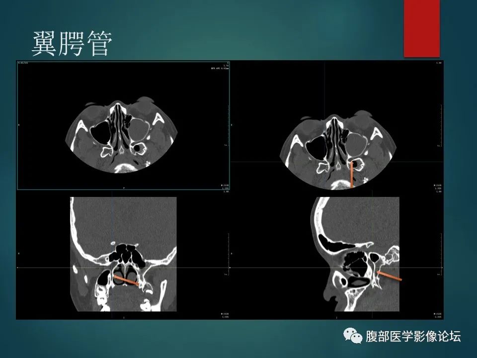 影像PPT - 【PPT】三叉孔道弯弯绕-85 影像PPT - 【PPT】三叉孔道弯弯绕-85