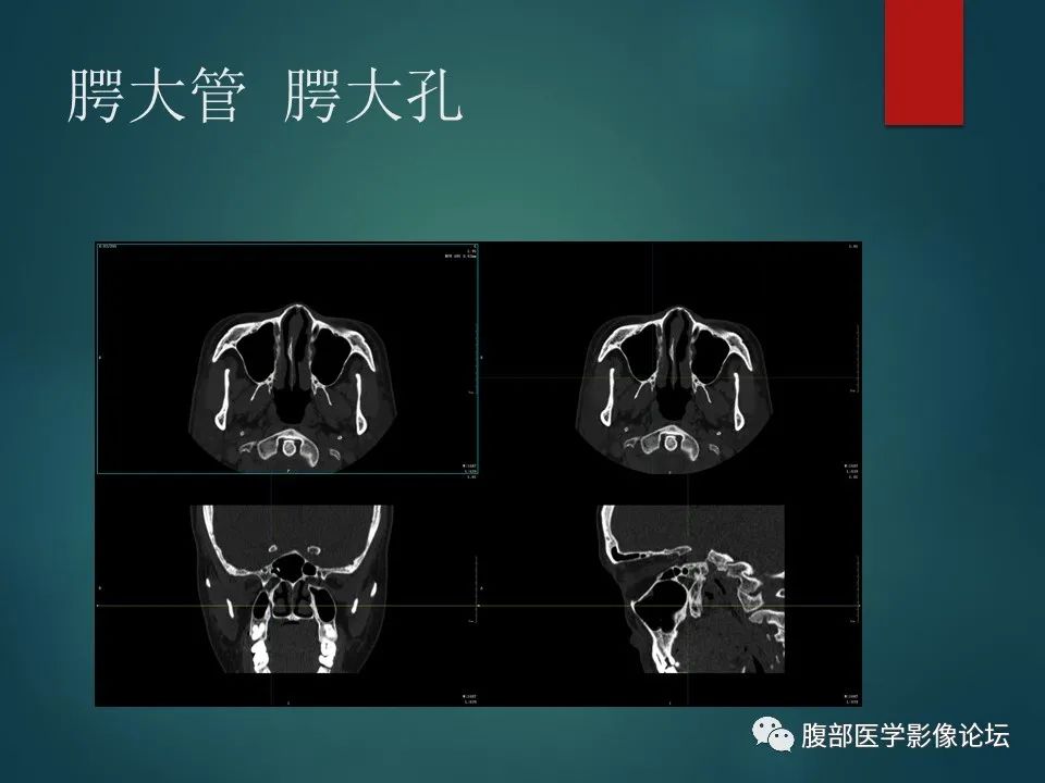 影像PPT - 【PPT】三叉孔道弯弯绕-86 影像PPT - 【PPT】三叉孔道弯弯绕-86