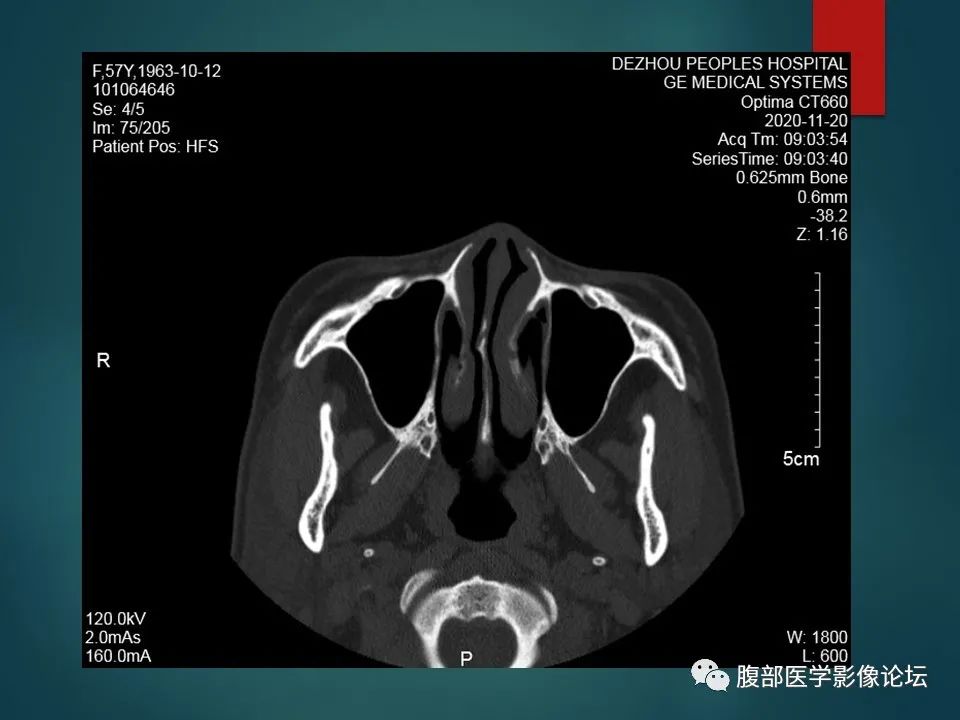 影像PPT - 【PPT】三叉孔道弯弯绕-87 影像PPT - 【PPT】三叉孔道弯弯绕-87