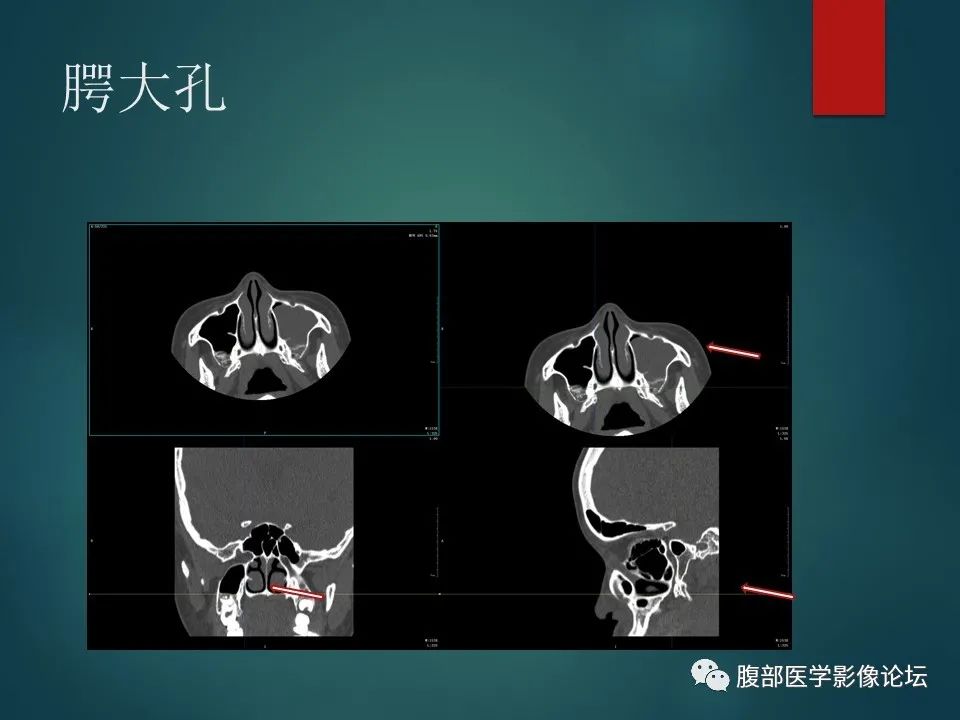 影像PPT - 【PPT】三叉孔道弯弯绕-89 影像PPT - 【PPT】三叉孔道弯弯绕-89