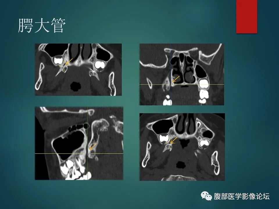 影像PPT - 【PPT】三叉孔道弯弯绕-90 影像PPT - 【PPT】三叉孔道弯弯绕-90