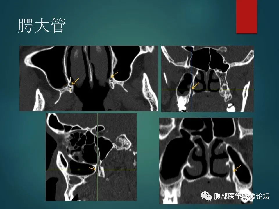 影像PPT - 【PPT】三叉孔道弯弯绕-91 影像PPT - 【PPT】三叉孔道弯弯绕-91
