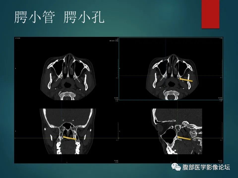 影像PPT - 【PPT】三叉孔道弯弯绕-92 影像PPT - 【PPT】三叉孔道弯弯绕-92