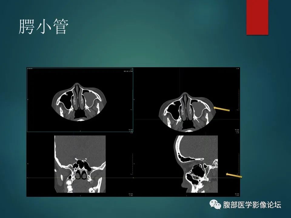 影像PPT - 【PPT】三叉孔道弯弯绕-93 影像PPT - 【PPT】三叉孔道弯弯绕-93