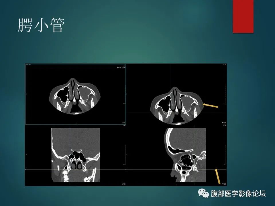 影像PPT - 【PPT】三叉孔道弯弯绕-94 影像PPT - 【PPT】三叉孔道弯弯绕-94