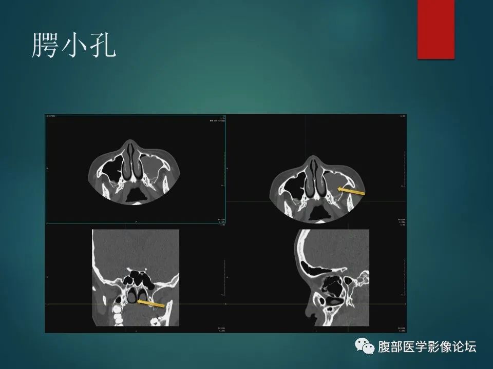影像PPT - 【PPT】三叉孔道弯弯绕-95 影像PPT - 【PPT】三叉孔道弯弯绕-95