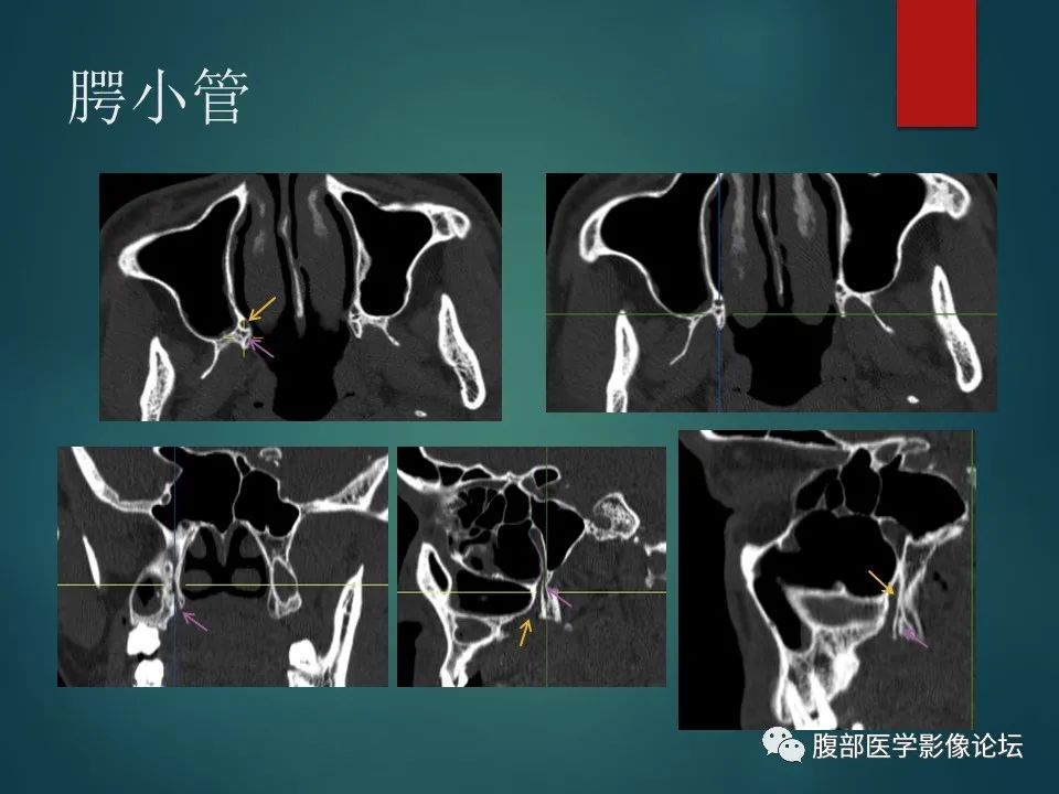 影像PPT - 【PPT】三叉孔道弯弯绕-96 影像PPT - 【PPT】三叉孔道弯弯绕-96
