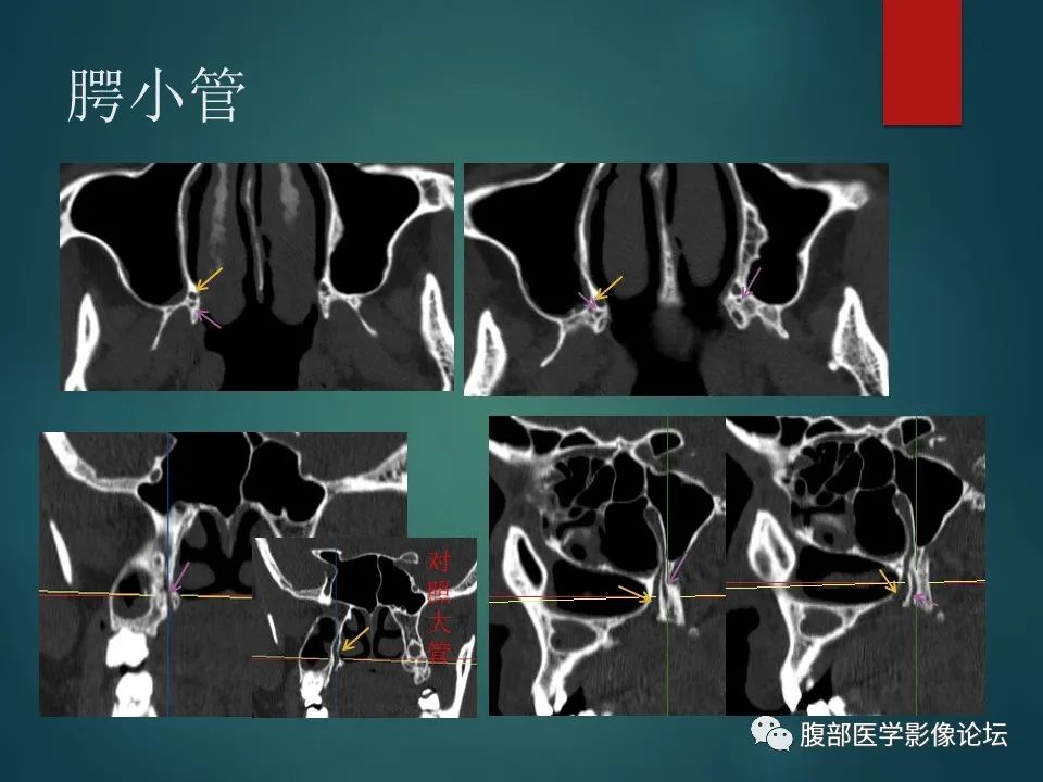 影像PPT - 【PPT】三叉孔道弯弯绕-97 影像PPT - 【PPT】三叉孔道弯弯绕-97