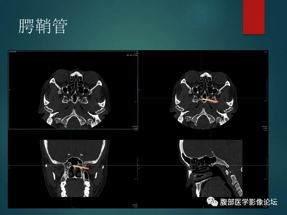 影像PPT - 【PPT】三叉孔道弯弯绕-99 影像PPT - 【PPT】三叉孔道弯弯绕-99