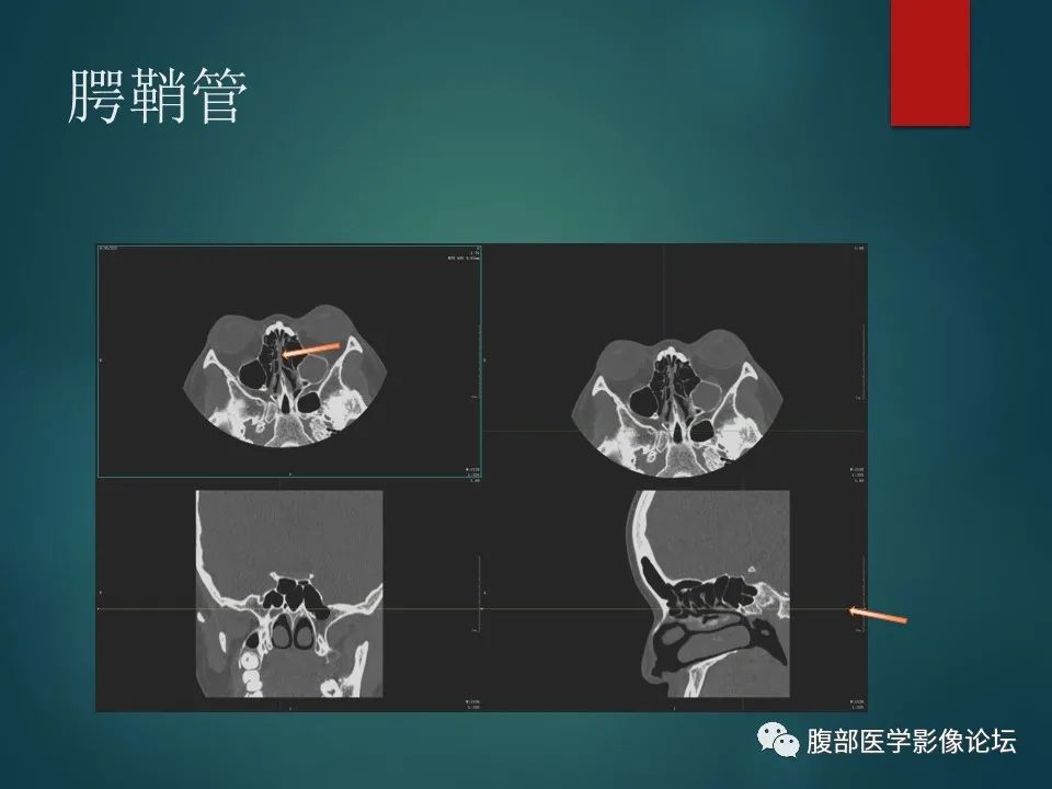 影像PPT - 【PPT】三叉孔道弯弯绕-100 影像PPT - 【PPT】三叉孔道弯弯绕-100