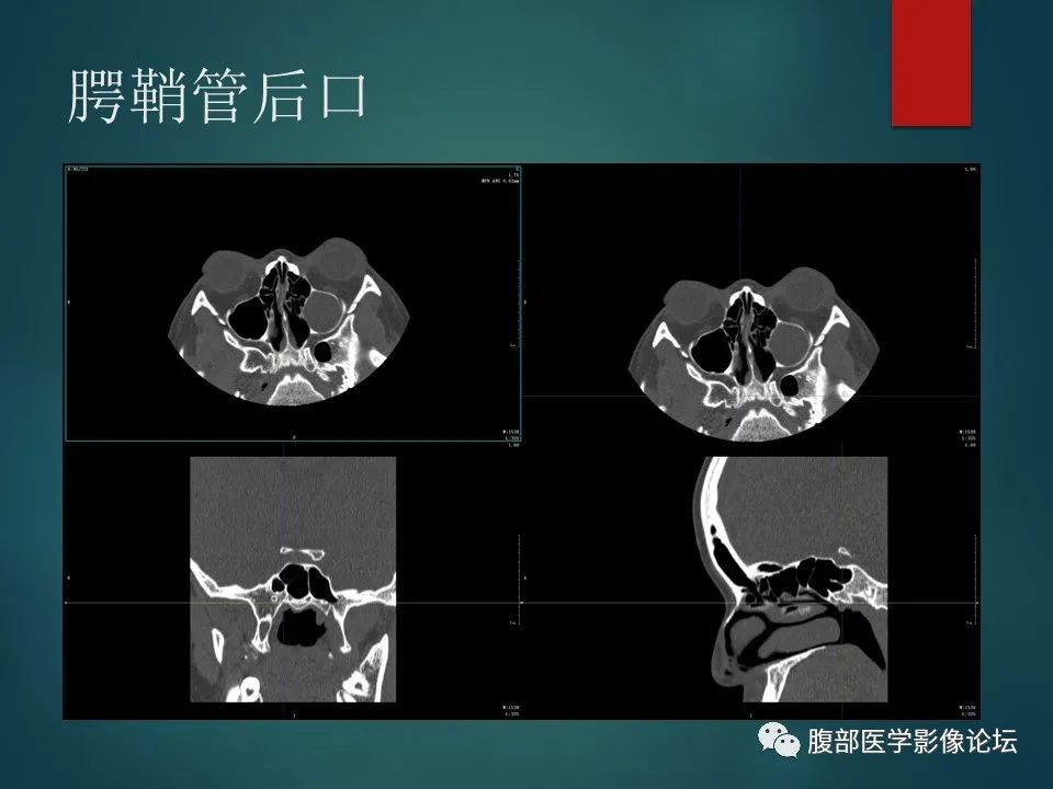 影像PPT - 【PPT】三叉孔道弯弯绕-102 影像PPT - 【PPT】三叉孔道弯弯绕-102