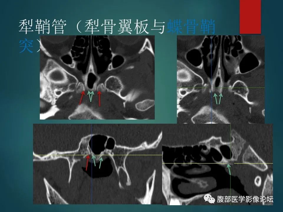 影像PPT - 【PPT】三叉孔道弯弯绕-104 影像PPT - 【PPT】三叉孔道弯弯绕-104