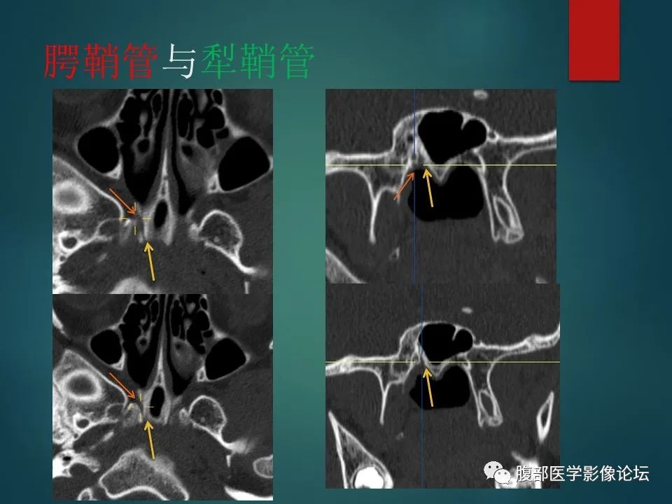 影像PPT - 【PPT】三叉孔道弯弯绕-105 影像PPT - 【PPT】三叉孔道弯弯绕-105
