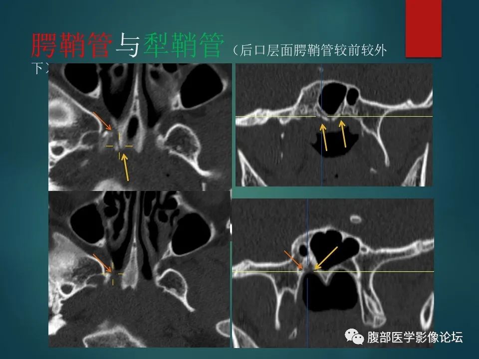 影像PPT - 【PPT】三叉孔道弯弯绕-106 影像PPT - 【PPT】三叉孔道弯弯绕-106