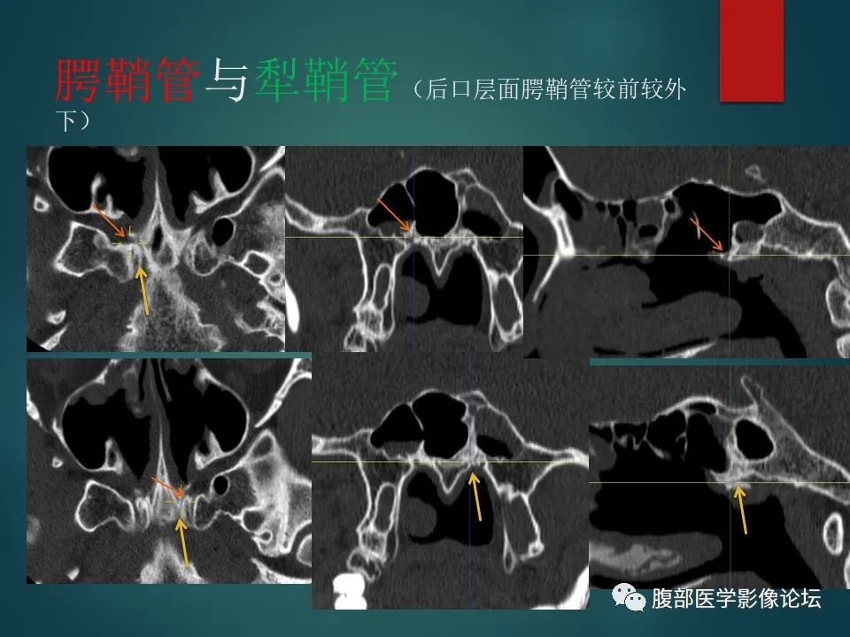影像PPT - 【PPT】三叉孔道弯弯绕-107 影像PPT - 【PPT】三叉孔道弯弯绕-107