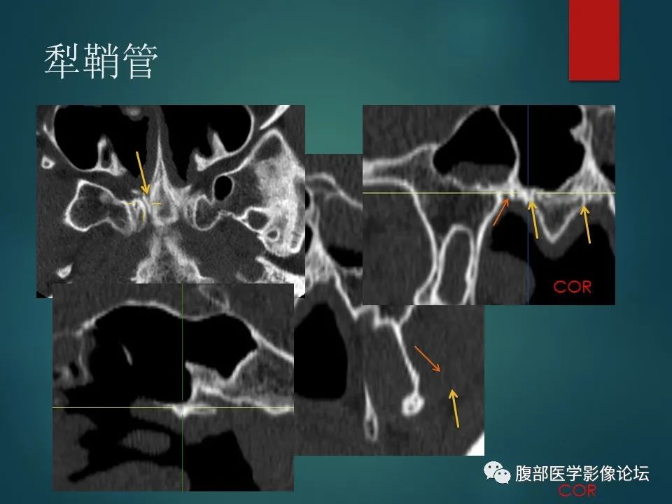 影像PPT - 【PPT】三叉孔道弯弯绕-108 影像PPT - 【PPT】三叉孔道弯弯绕-108