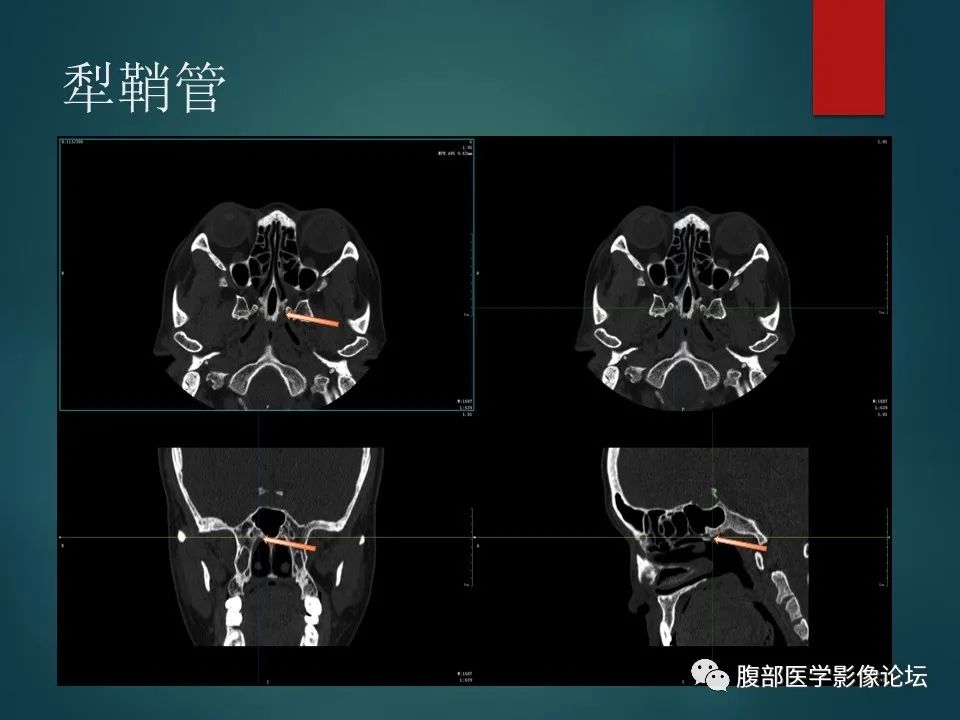 影像PPT - 【PPT】三叉孔道弯弯绕-109 影像PPT - 【PPT】三叉孔道弯弯绕-109