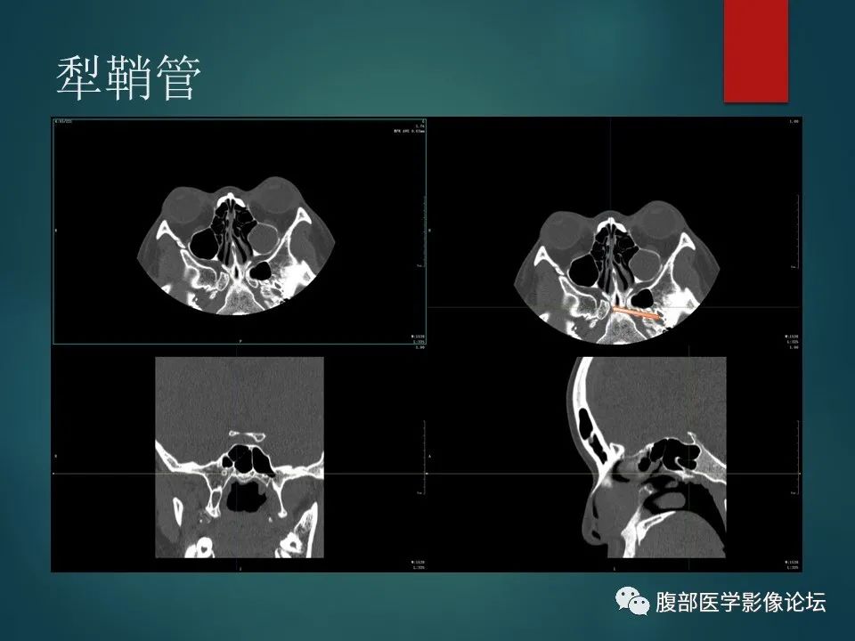 影像PPT - 【PPT】三叉孔道弯弯绕-110 影像PPT - 【PPT】三叉孔道弯弯绕-110