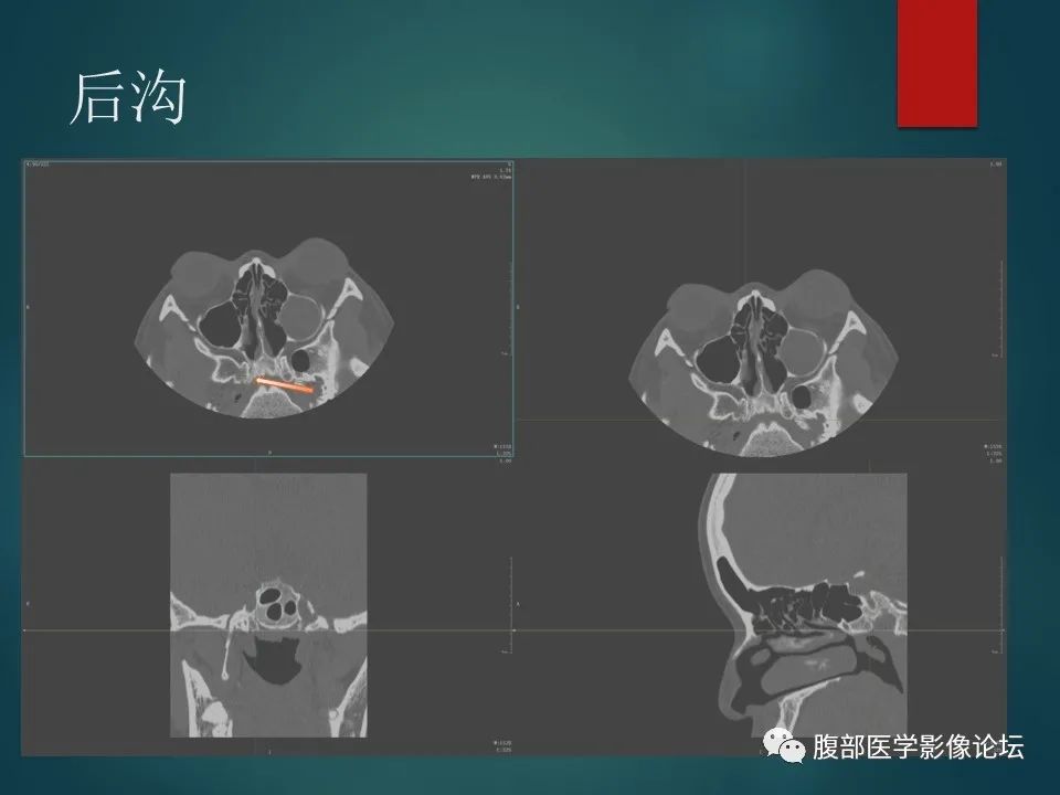 影像PPT - 【PPT】三叉孔道弯弯绕-112 影像PPT - 【PPT】三叉孔道弯弯绕-112