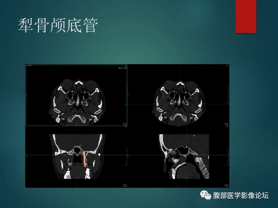 影像PPT - 【PPT】三叉孔道弯弯绕-113 影像PPT - 【PPT】三叉孔道弯弯绕-113
