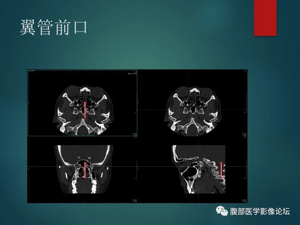 影像PPT - 【PPT】三叉孔道弯弯绕-114 影像PPT - 【PPT】三叉孔道弯弯绕-114