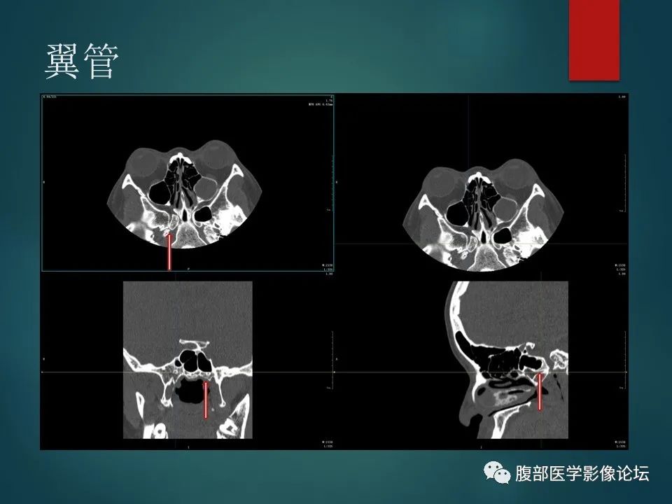 影像PPT - 【PPT】三叉孔道弯弯绕-115 影像PPT - 【PPT】三叉孔道弯弯绕-115