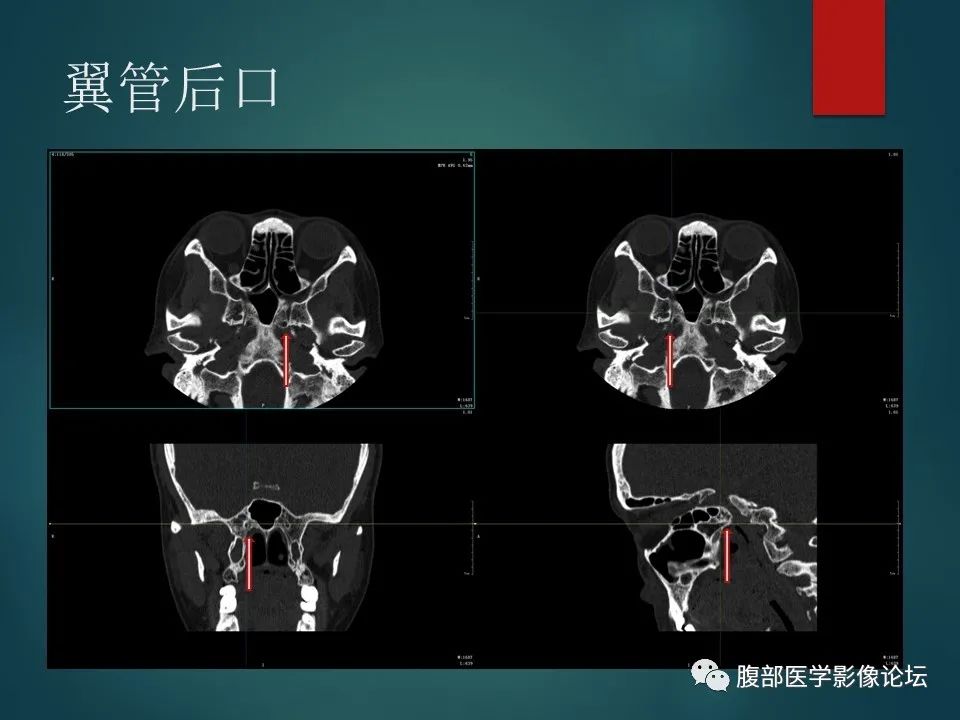影像PPT - 【PPT】三叉孔道弯弯绕-116 影像PPT - 【PPT】三叉孔道弯弯绕-116