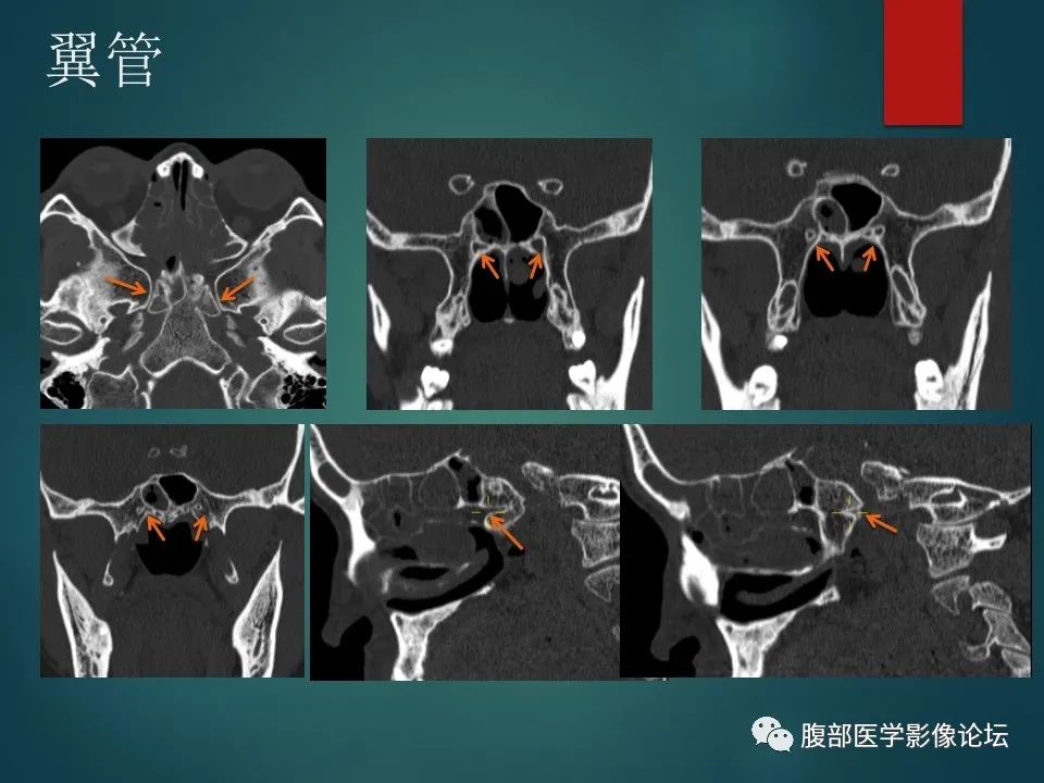 影像PPT - 【PPT】三叉孔道弯弯绕-117 影像PPT - 【PPT】三叉孔道弯弯绕-117