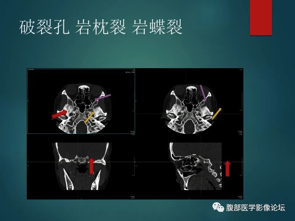 影像PPT - 【PPT】三叉孔道弯弯绕-118 影像PPT - 【PPT】三叉孔道弯弯绕-118