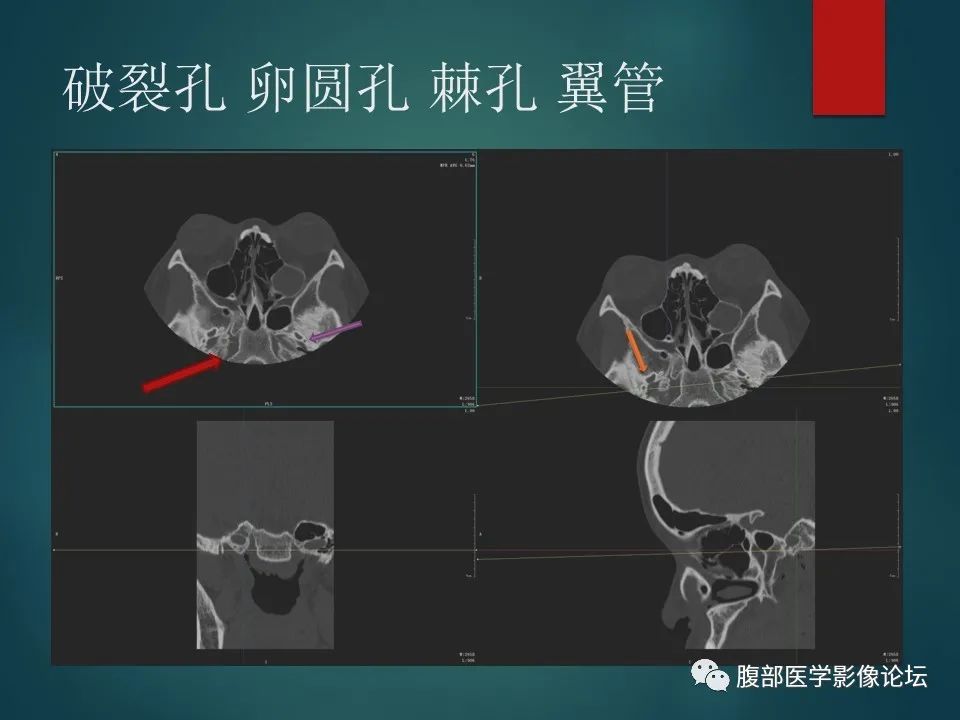 影像PPT - 【PPT】三叉孔道弯弯绕-119 影像PPT - 【PPT】三叉孔道弯弯绕-119
