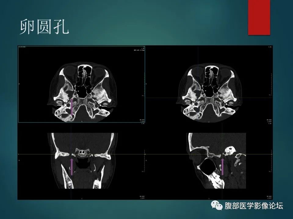 影像PPT - 【PPT】三叉孔道弯弯绕-120 影像PPT - 【PPT】三叉孔道弯弯绕-120