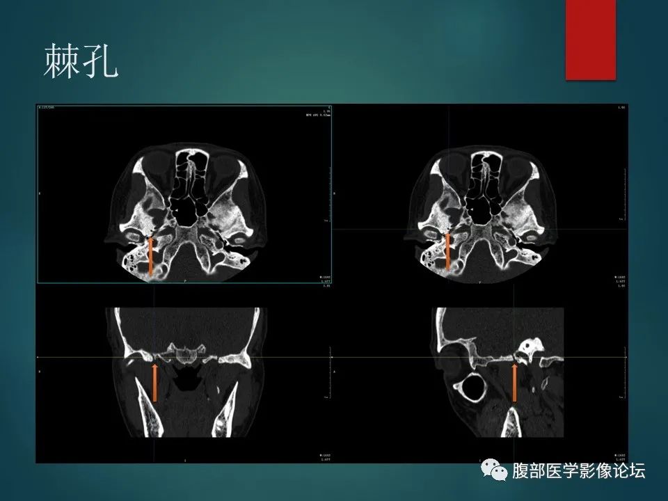 影像PPT - 【PPT】三叉孔道弯弯绕-121 影像PPT - 【PPT】三叉孔道弯弯绕-121