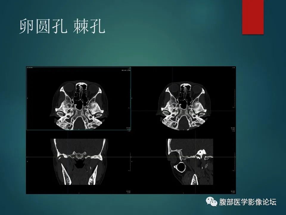 影像PPT - 【PPT】三叉孔道弯弯绕-122 影像PPT - 【PPT】三叉孔道弯弯绕-122