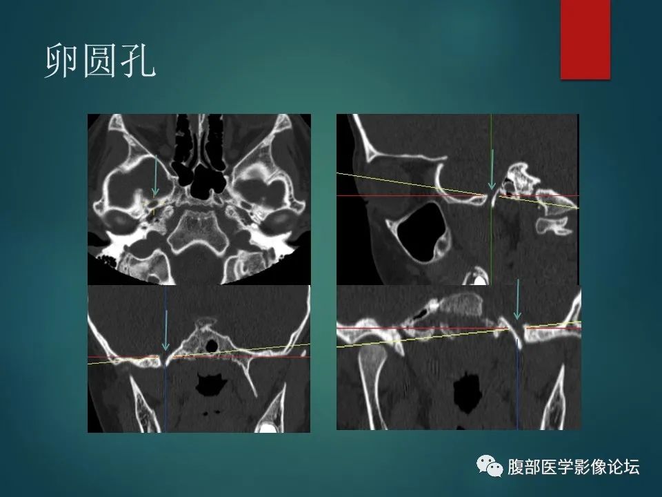 影像PPT - 【PPT】三叉孔道弯弯绕-123 影像PPT - 【PPT】三叉孔道弯弯绕-123