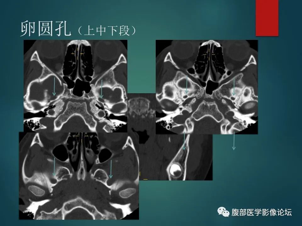 影像PPT - 【PPT】三叉孔道弯弯绕-124 影像PPT - 【PPT】三叉孔道弯弯绕-124
