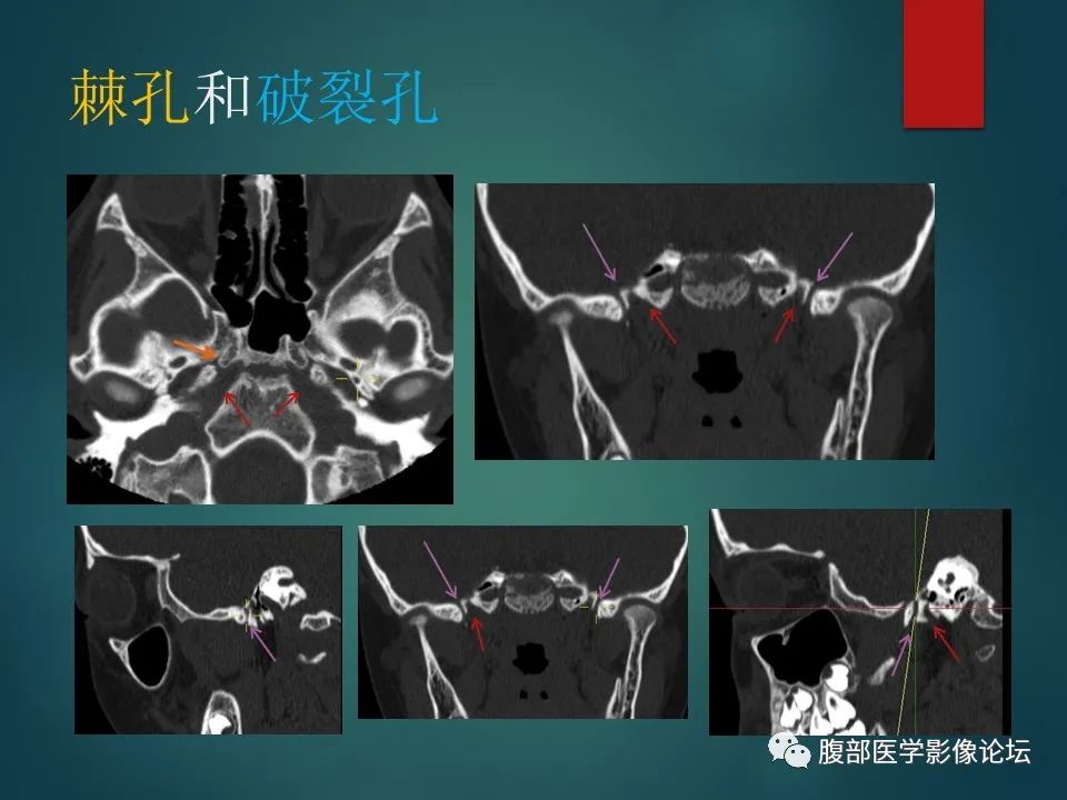 影像PPT - 【PPT】三叉孔道弯弯绕-125 影像PPT - 【PPT】三叉孔道弯弯绕-125