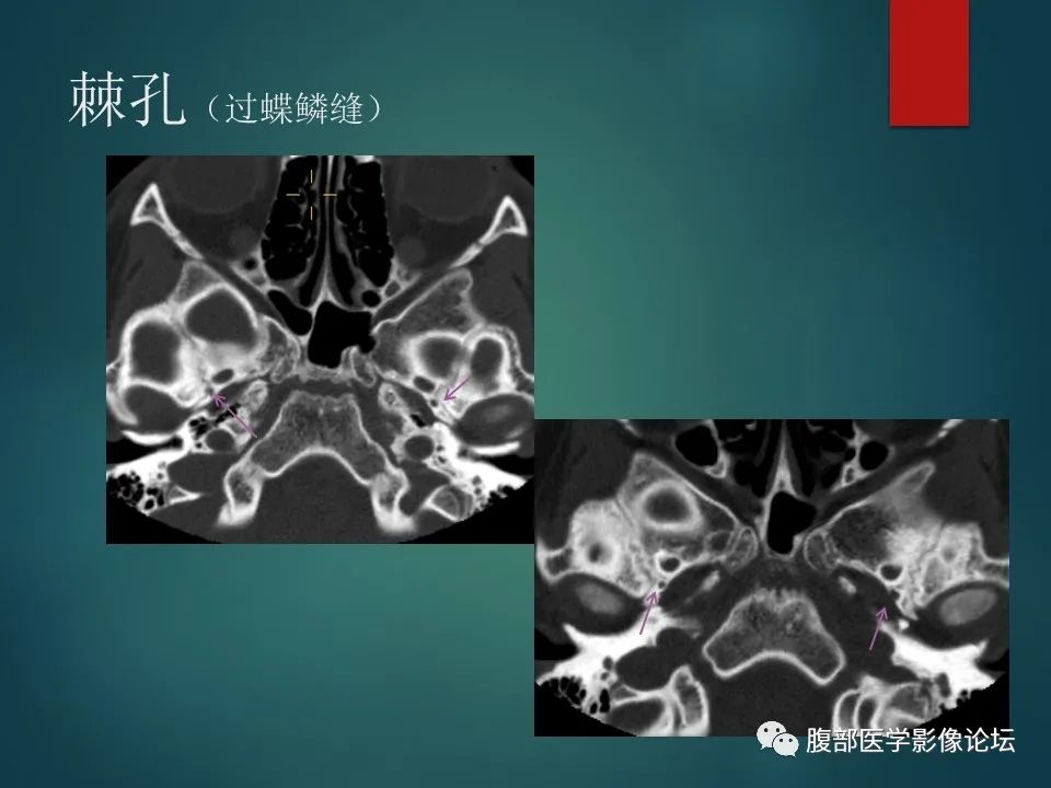 影像PPT - 【PPT】三叉孔道弯弯绕-126 影像PPT - 【PPT】三叉孔道弯弯绕-126