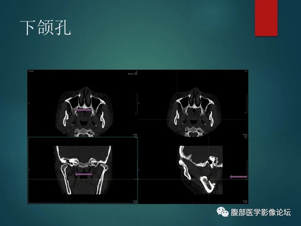 影像PPT - 【PPT】三叉孔道弯弯绕-127 影像PPT - 【PPT】三叉孔道弯弯绕-127