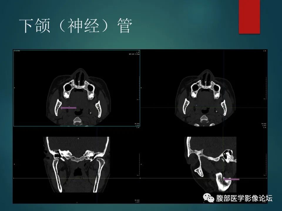 影像PPT - 【PPT】三叉孔道弯弯绕-128 影像PPT - 【PPT】三叉孔道弯弯绕-128