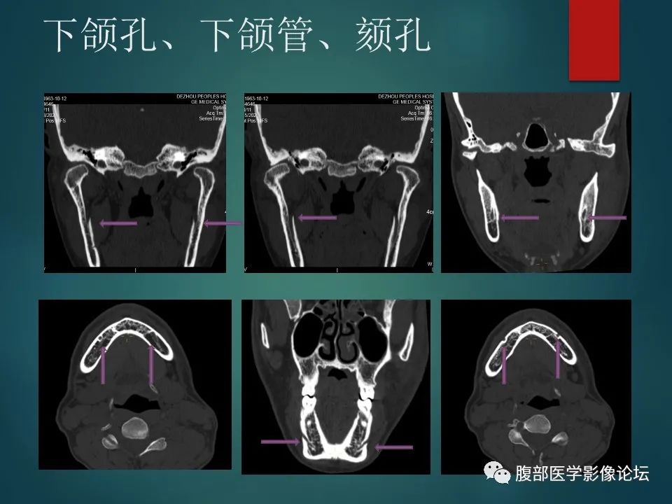 影像PPT - 【PPT】三叉孔道弯弯绕-129 影像PPT - 【PPT】三叉孔道弯弯绕-129