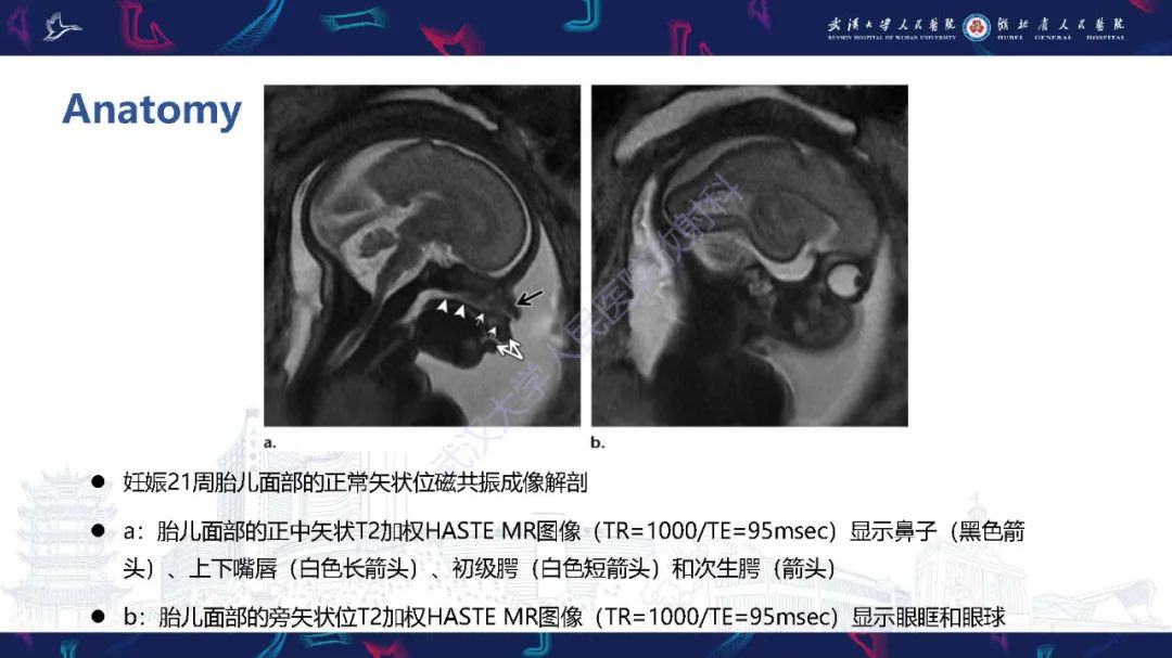 影像PPT - 【PPT】胎儿面部畸形MR诊断-6