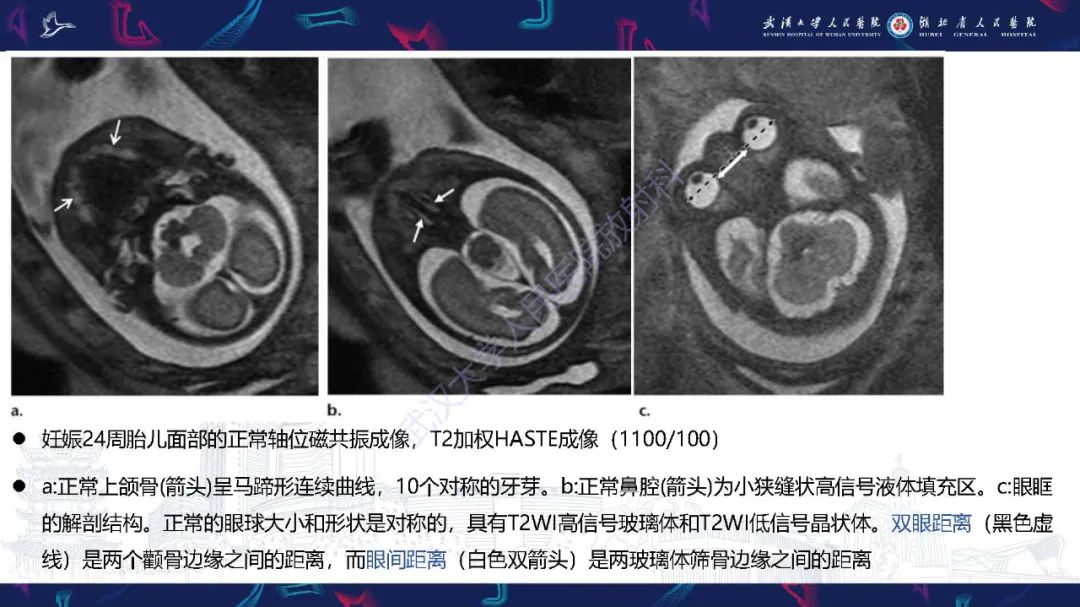影像PPT - 【PPT】胎儿面部畸形MR诊断-8
