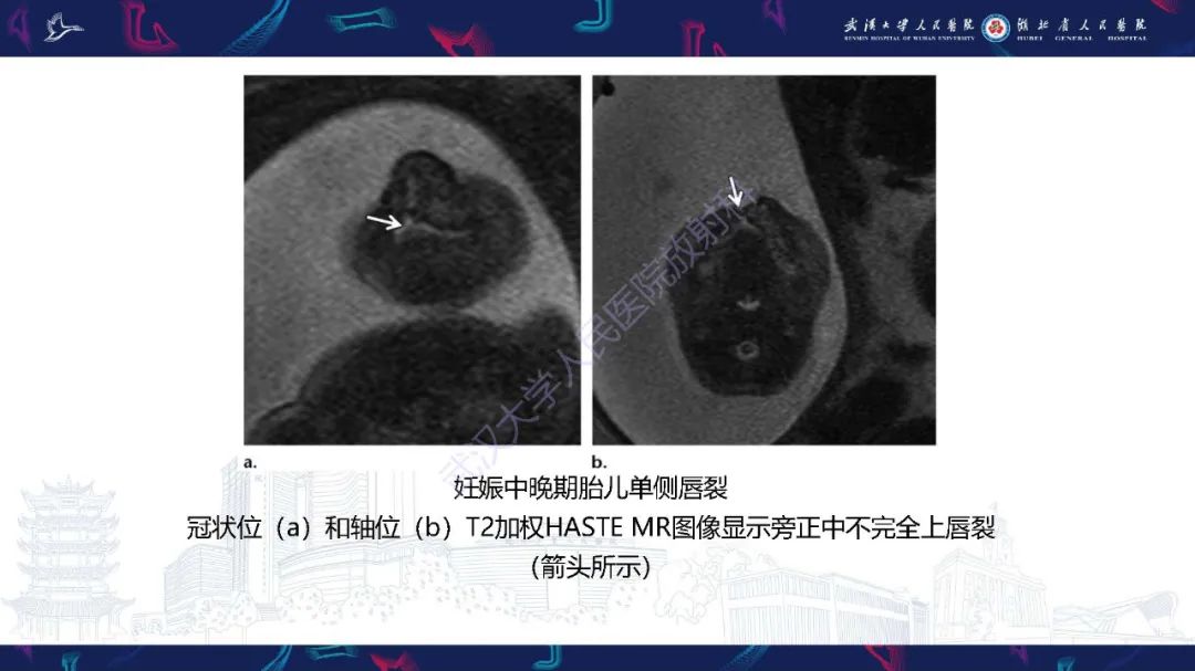影像PPT - 【PPT】胎儿面部畸形MR诊断-19