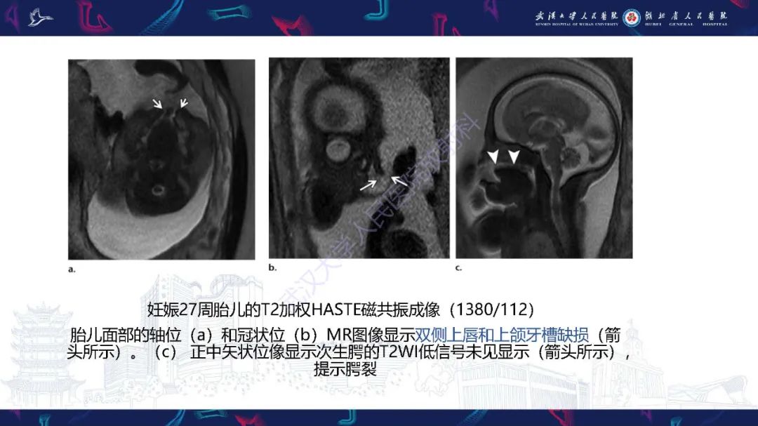 影像PPT - 【PPT】胎儿面部畸形MR诊断-20