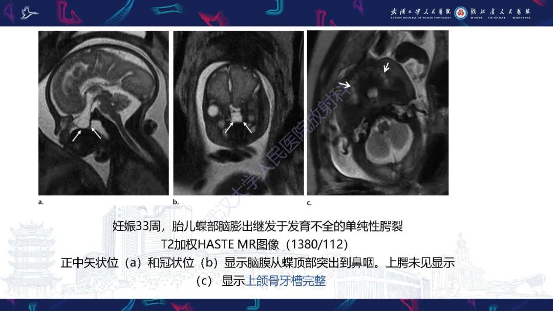 影像PPT - 【PPT】胎儿面部畸形MR诊断-23