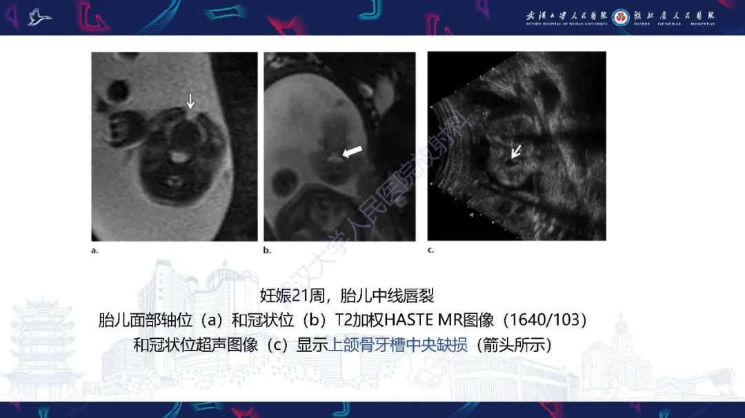 影像PPT - 【PPT】胎儿面部畸形MR诊断-25